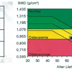 Osteoporose werte tabelle: Röntgenaufnahme der Lendenwirbel und eine Grafik, die den T-Wert im Verhältnis zum Alter zeigt. Grün: Normal, Gelb: Osteopenie, Rot: Osteoporose.