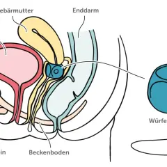 Schema des weiblichen Beckens mit Harnblase, Gebärmutter und Enddarm. Ein Würfelpessar wird gezeigt, dessen Nachteile hier nicht thematisiert werden.