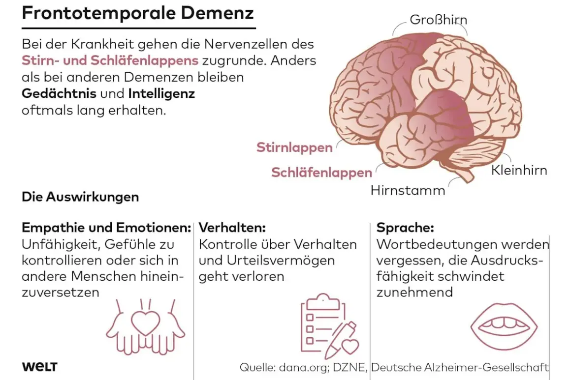 Gehirnabbildung erklärt frontotemporale Demenz, die Nervenzellen im Stirn- und Schläfenlappen schädigt, was zu Empathie-, Verhaltens- und Sprachverlust führt.