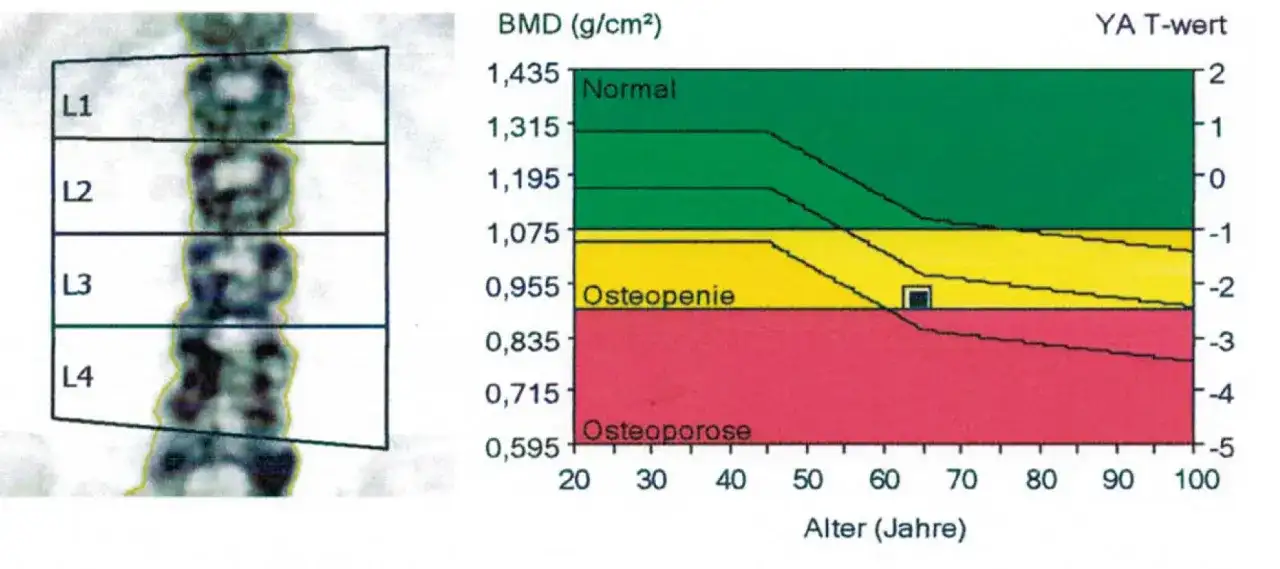 Osteoporose-Wertetabelle - So deuten Sie T-Score & Z-Score richtig